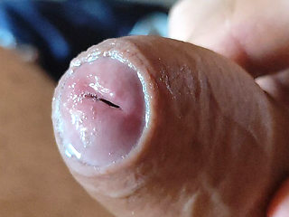 Deep Split in the Glans Produces Bubbling Liquid