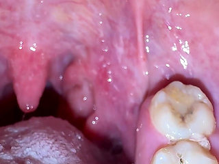 Mouth Secrets: Thick White Coating on My Tongue