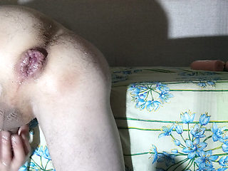 Anal prolapse
