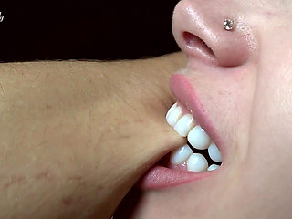 Hard biting of male fingers and arm